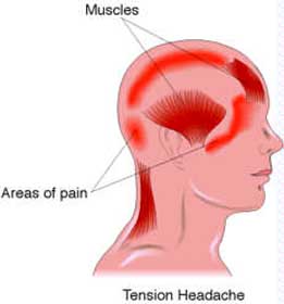 How to manage your tension Headache